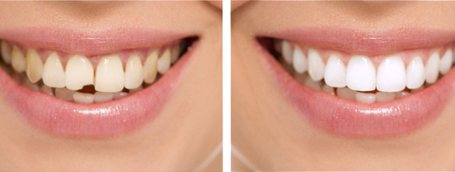 Зубной ряд до и после реставрации